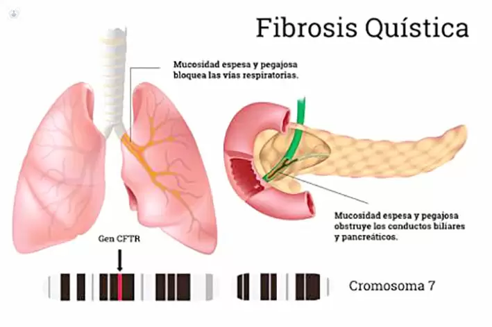 fibrosis qustica ejemplo