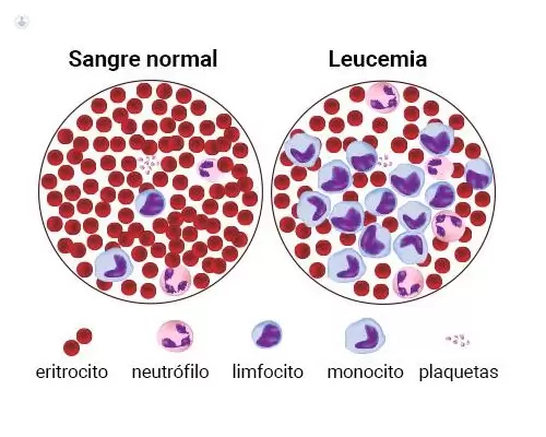 leucemia